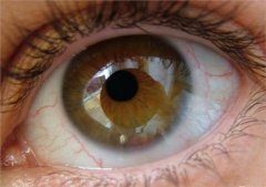 干眼症是怎么引起的？